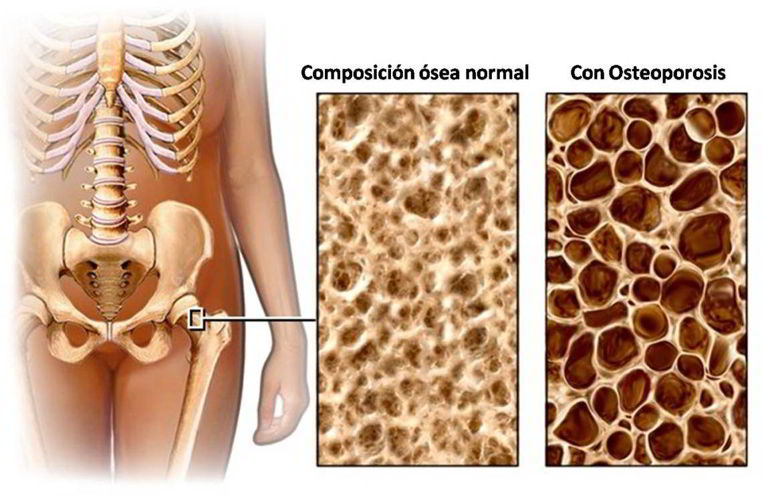 causas de osteoporosis en adultos